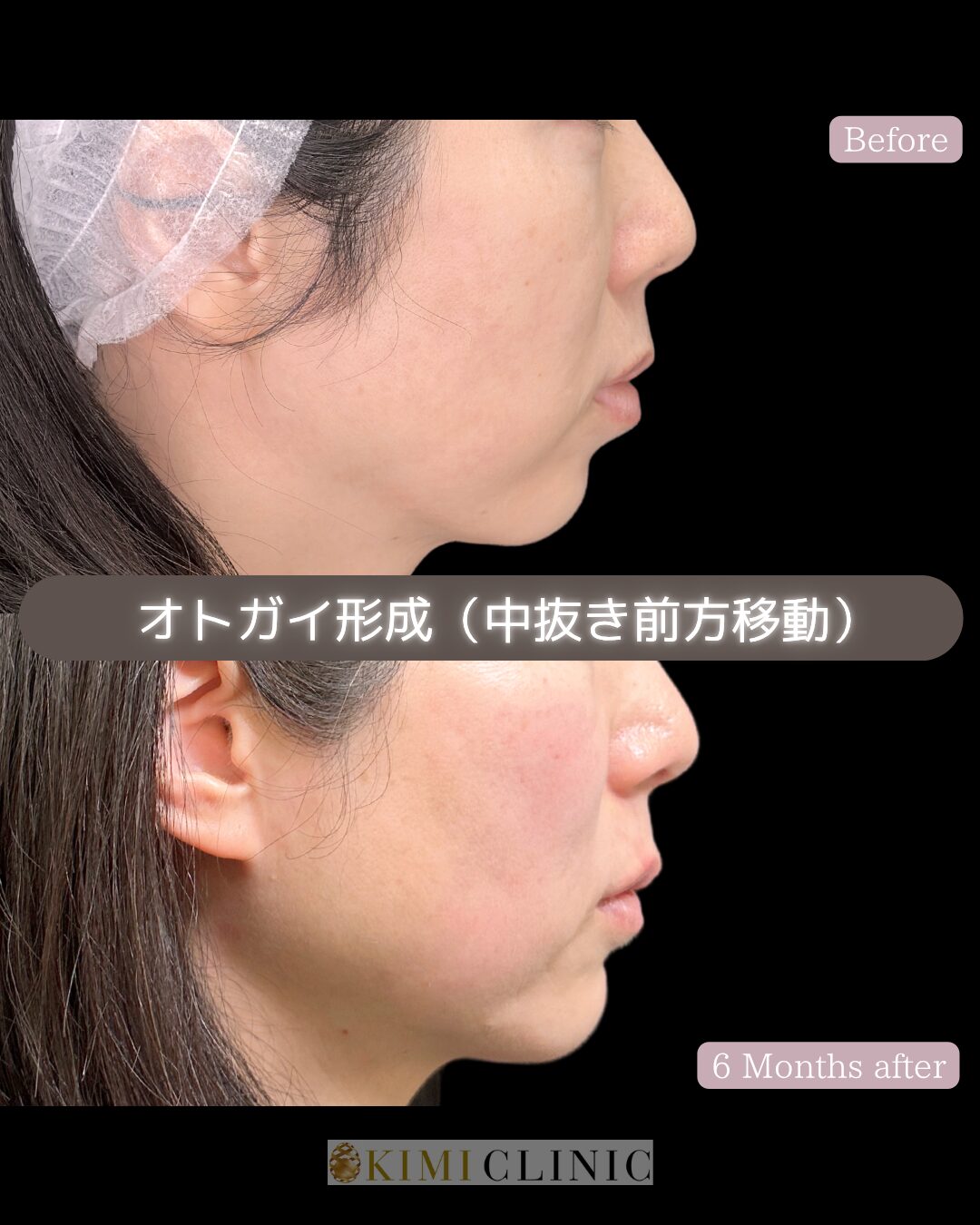 「オトガイ形成術（輪郭骨切り、水平骨切り前方移動）」の術前・術後比較Before写真