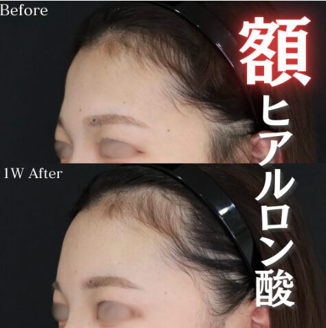 「額ヒアルロン酸」の術前・術後比較Before写真