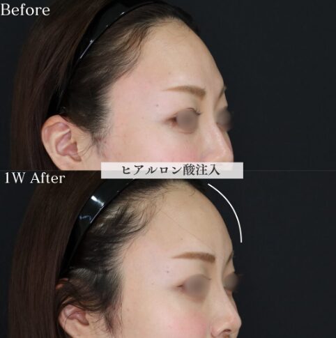 「額ヒアルロン酸」の術前・術後比較Before写真