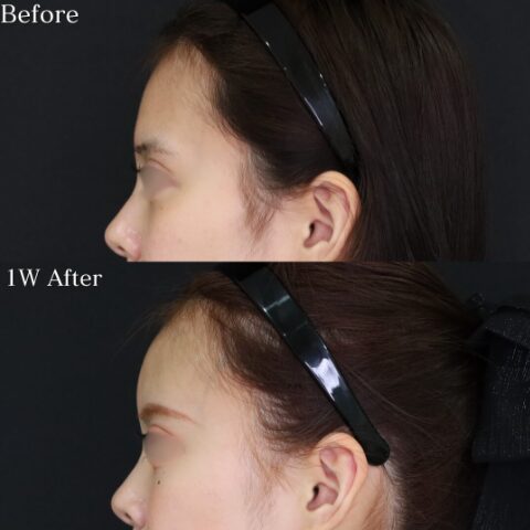 「額ヒアルロン酸」の術前・術後比較Before写真