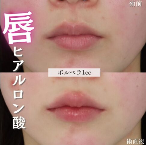 「唇ヒアルロン酸」の術前・術後比較Before写真