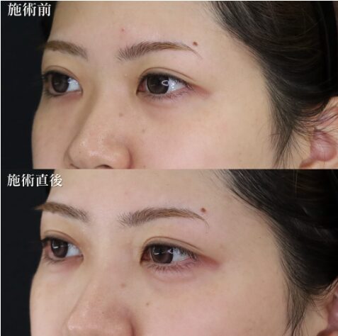 「涙袋ヒアルロン酸」の術前・術後比較Before写真
