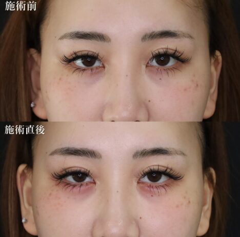「涙袋ヒアルロン酸」の術前・術後比較Before写真