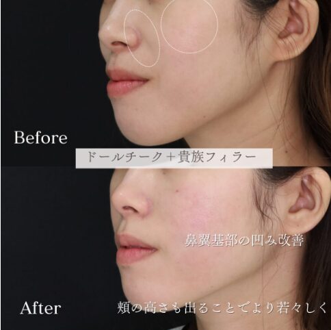 「鼻翼基部×チークトップヒアル」の術前・術後比較Before写真