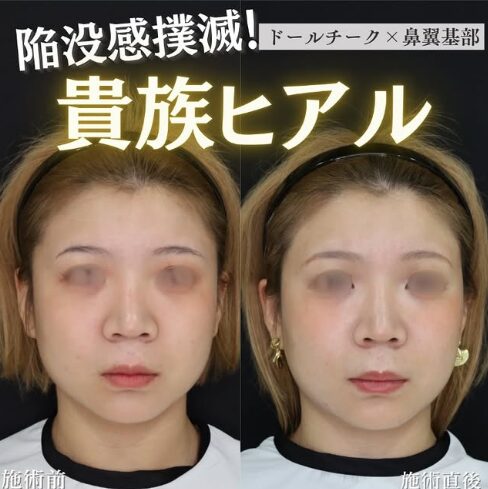 「貴族フィラー×チークトップヒアル」の術前・術後比較Before写真