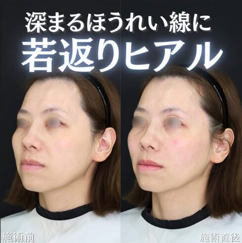 「エイジングヒアル」の術前・術後比較Before写真