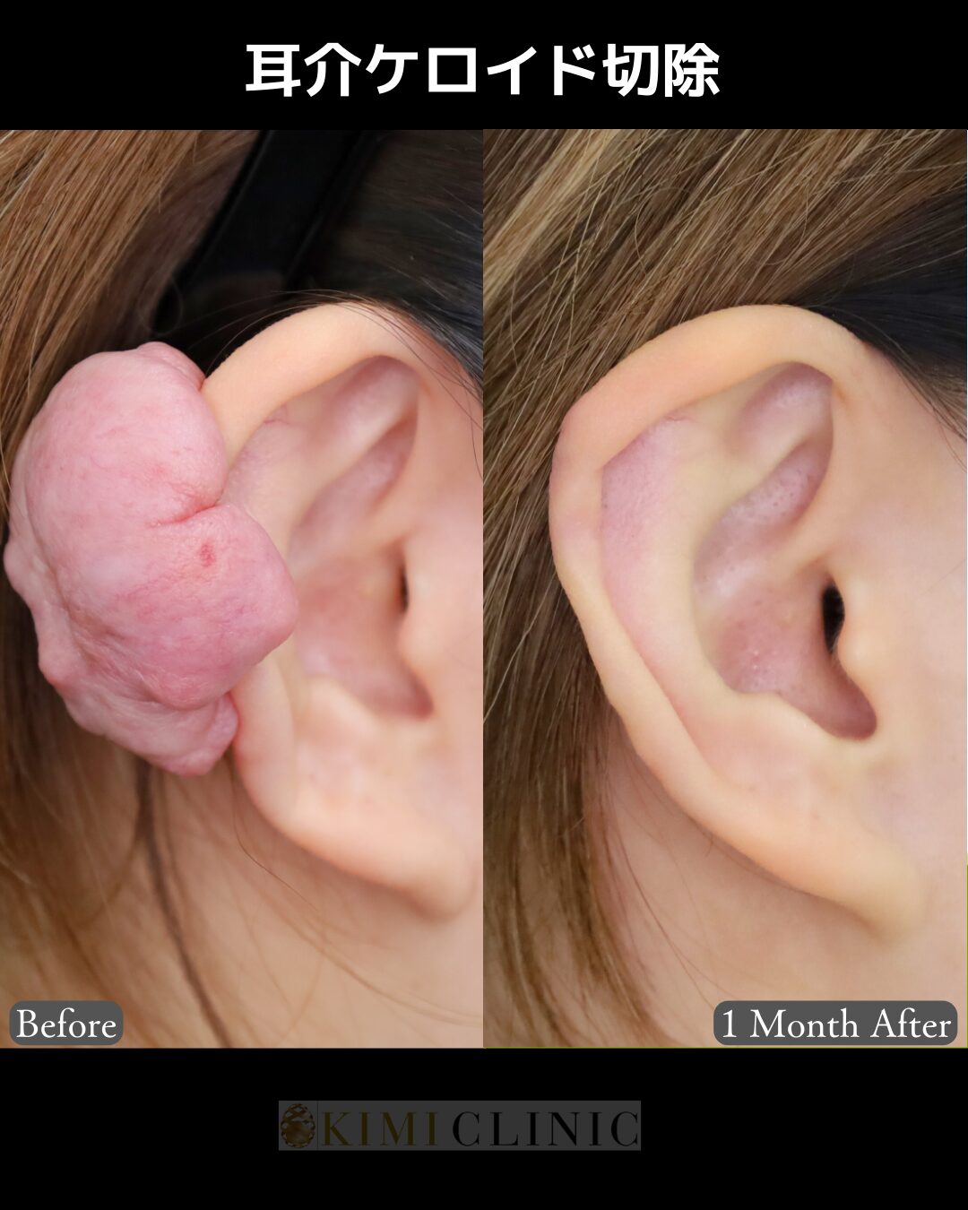 「耳介ケロイド切除」の術前・術後比較Before写真