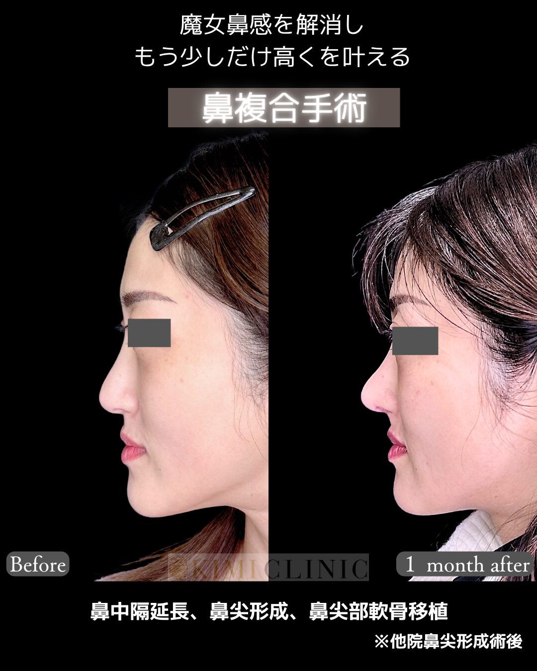 「他院修正の鼻尖部複合手術」の術前・術後比較Before写真