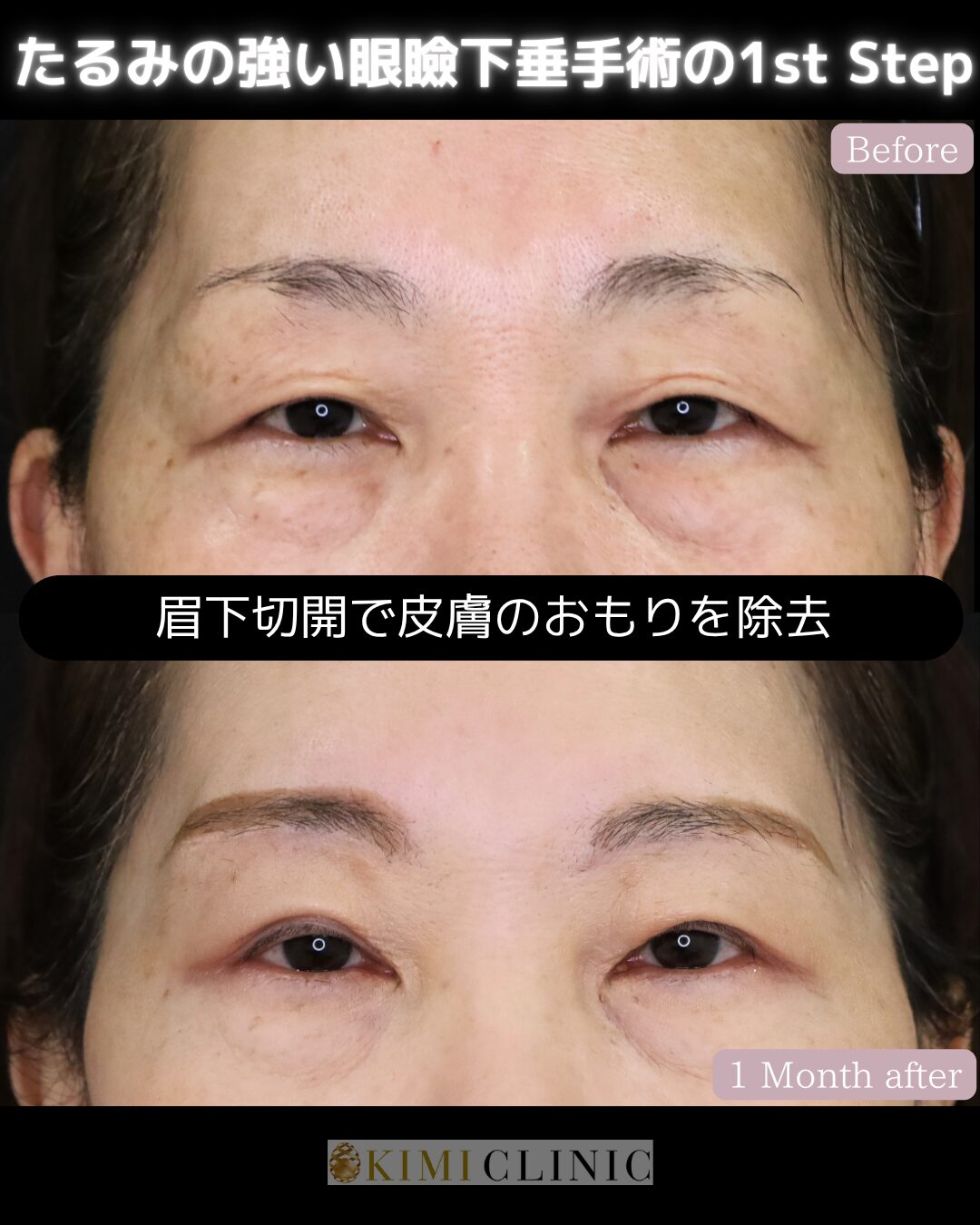 「老人性眼瞼下垂症に対する眉下切開」の術前・術後比較Before写真