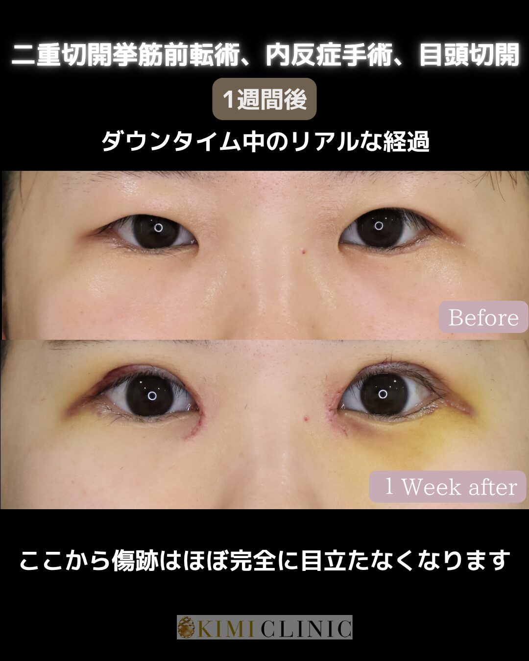 「眼瞼下垂手術 × 内反症手術 × 目頭切開」の術後１週のダウンタイム経過Before写真