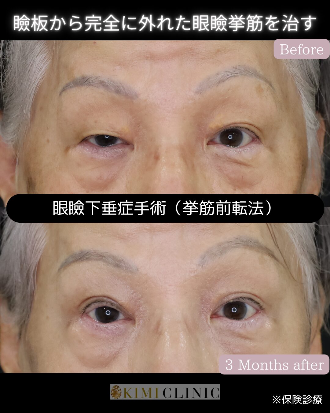 「眼瞼下垂（老人性＆緑内障治療薬による）に対する眼瞼下垂手術」の術前・術後比較Before写真