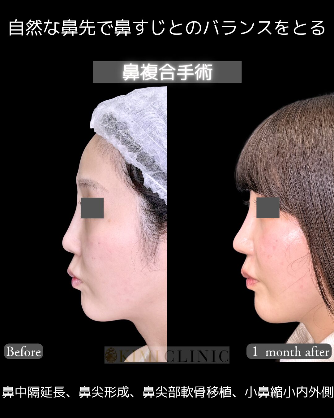 「鼻複合手術」の術前・術後比較Before写真