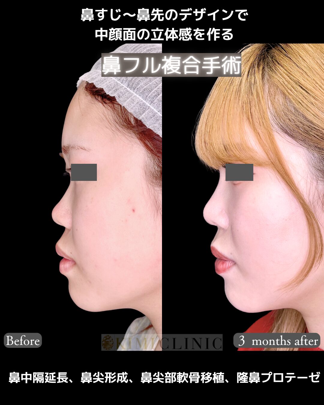 「鼻フル複合手術」の術前・術後比較Before写真