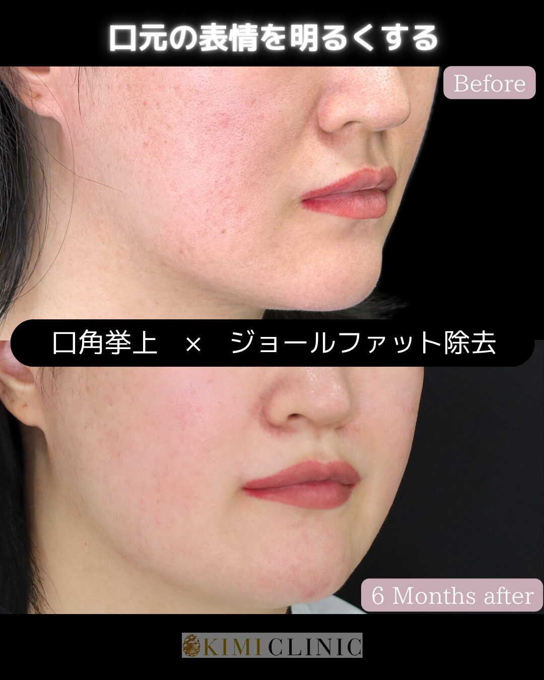 「ジョールファット除去 × 口角挙上」の術前・術後比較Before写真