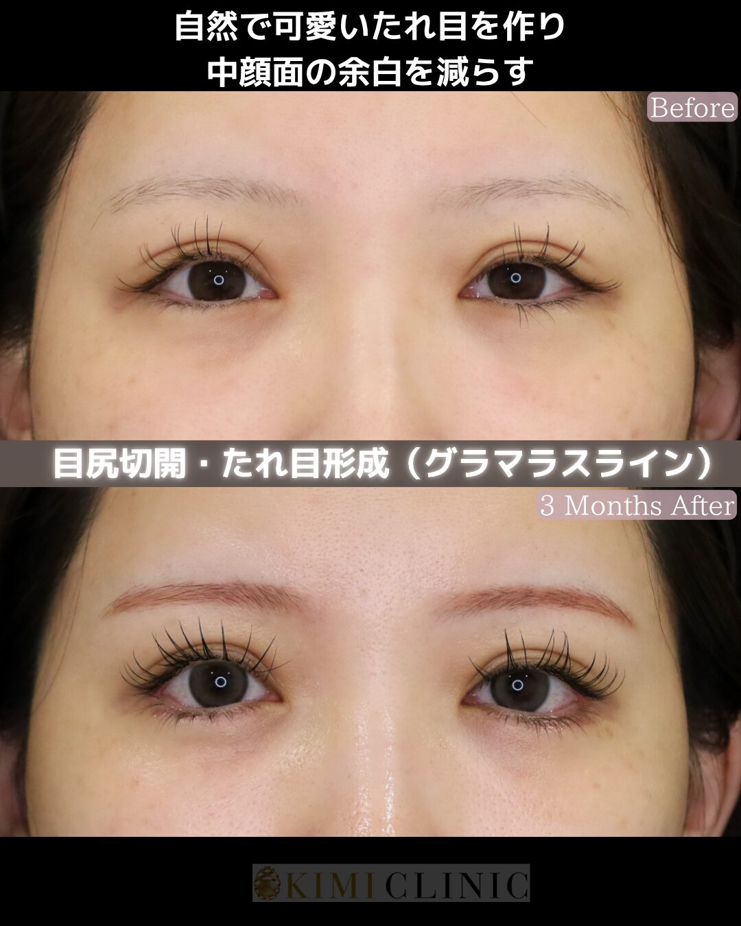 「目尻切開・たれ目形成（グラマラスライン）」の術前・術後比較Before写真