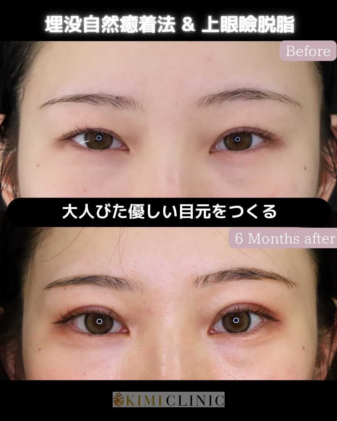 「キミクリの自然癒着法」の術前・術後比較Before写真