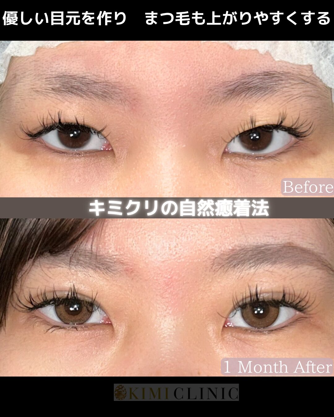 「キミクリの自然癒着法」の術前・術後比較Before写真