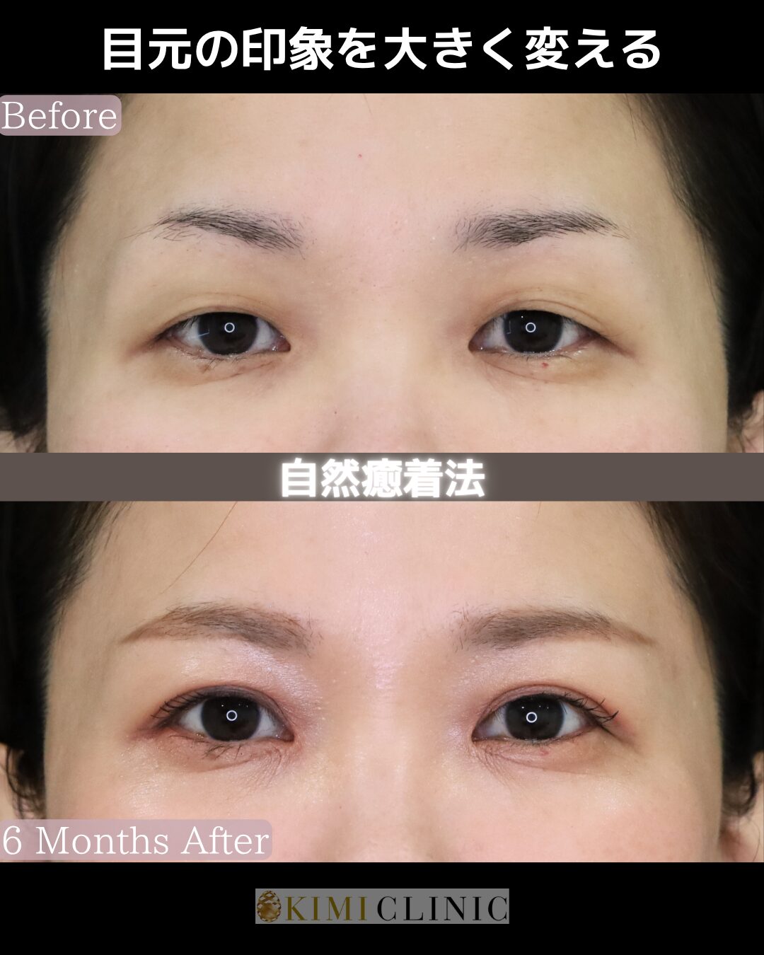 「キミクリの自然癒着法」の術前・術後比較Before写真