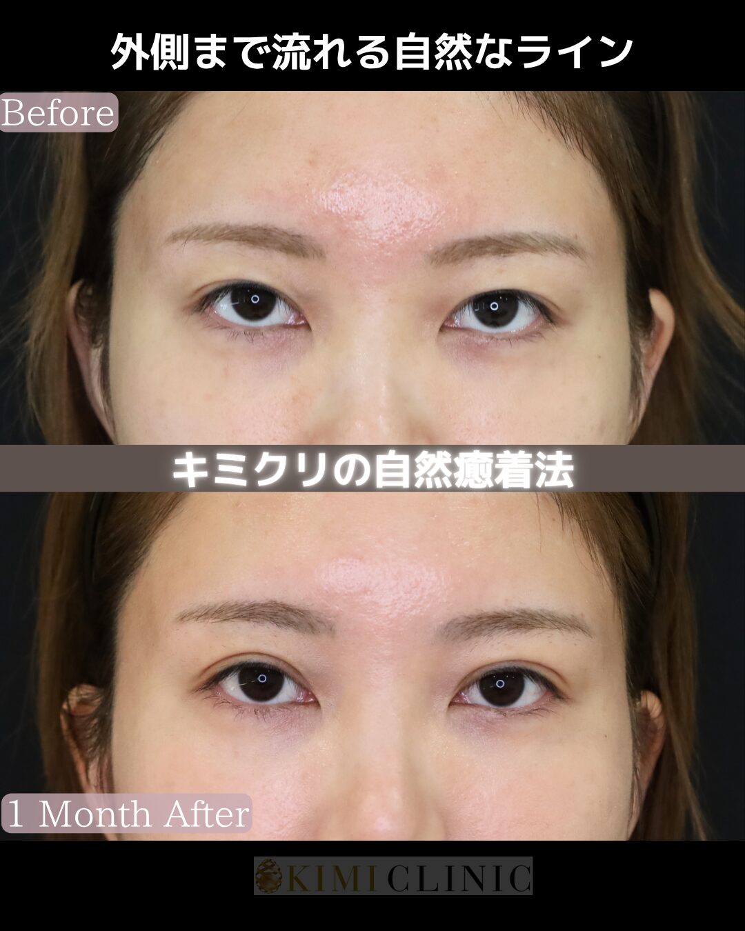 「キミクリの自然癒着法」の術前・術後比較Before写真