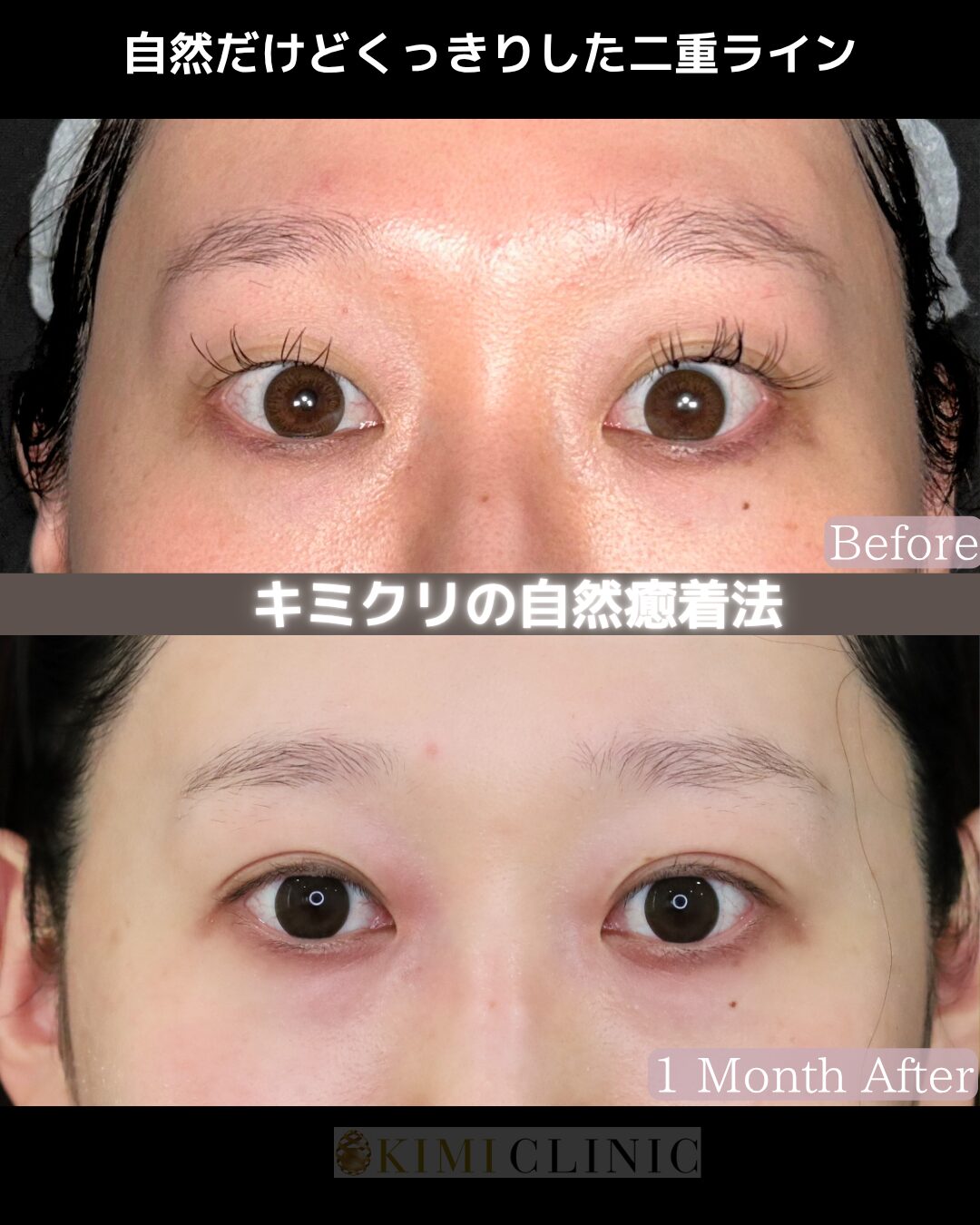 「キミクリの自然癒着法」の術前・術後比較Before写真