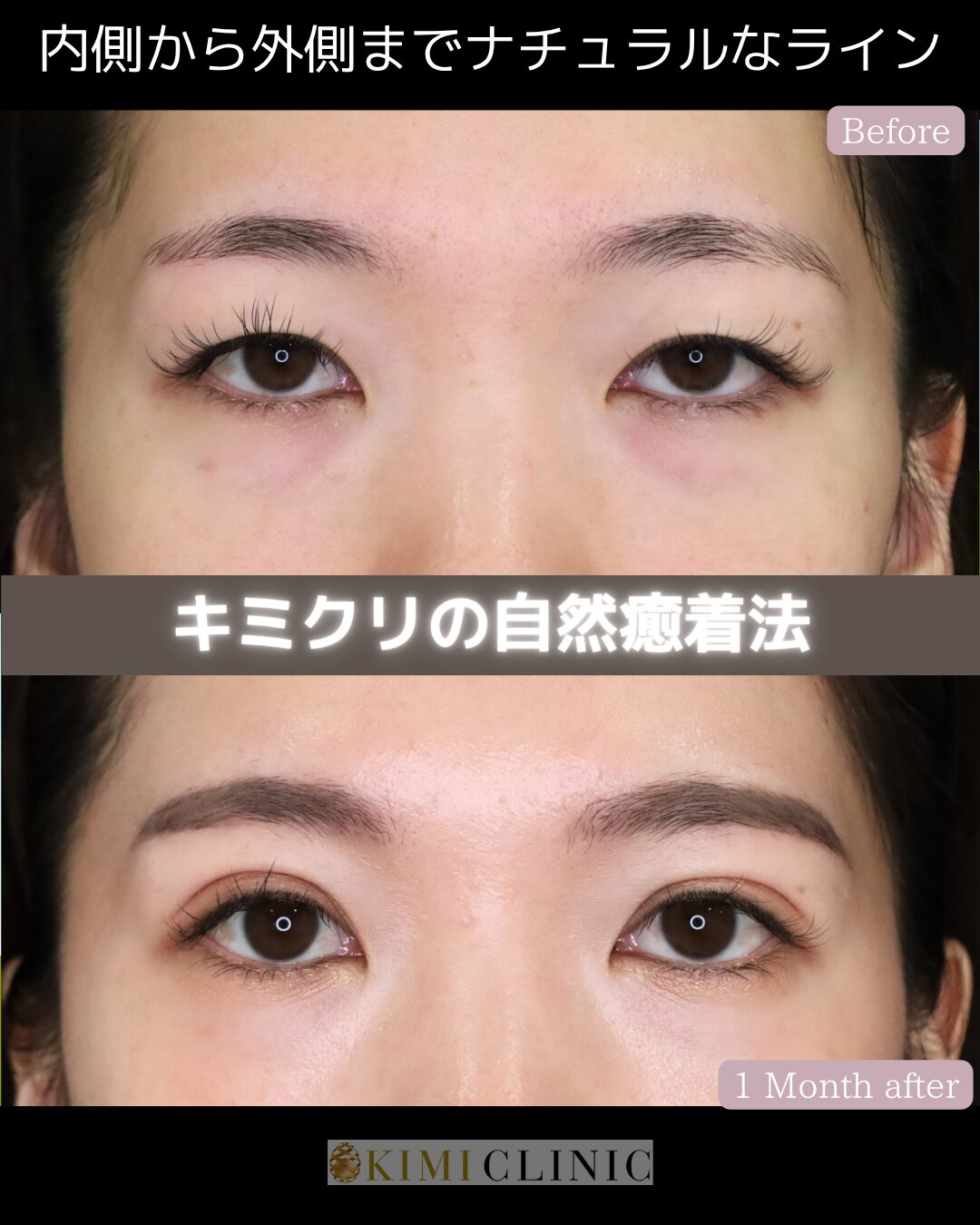 「キミクリの自然癒着法」の術前・術後比較Before写真