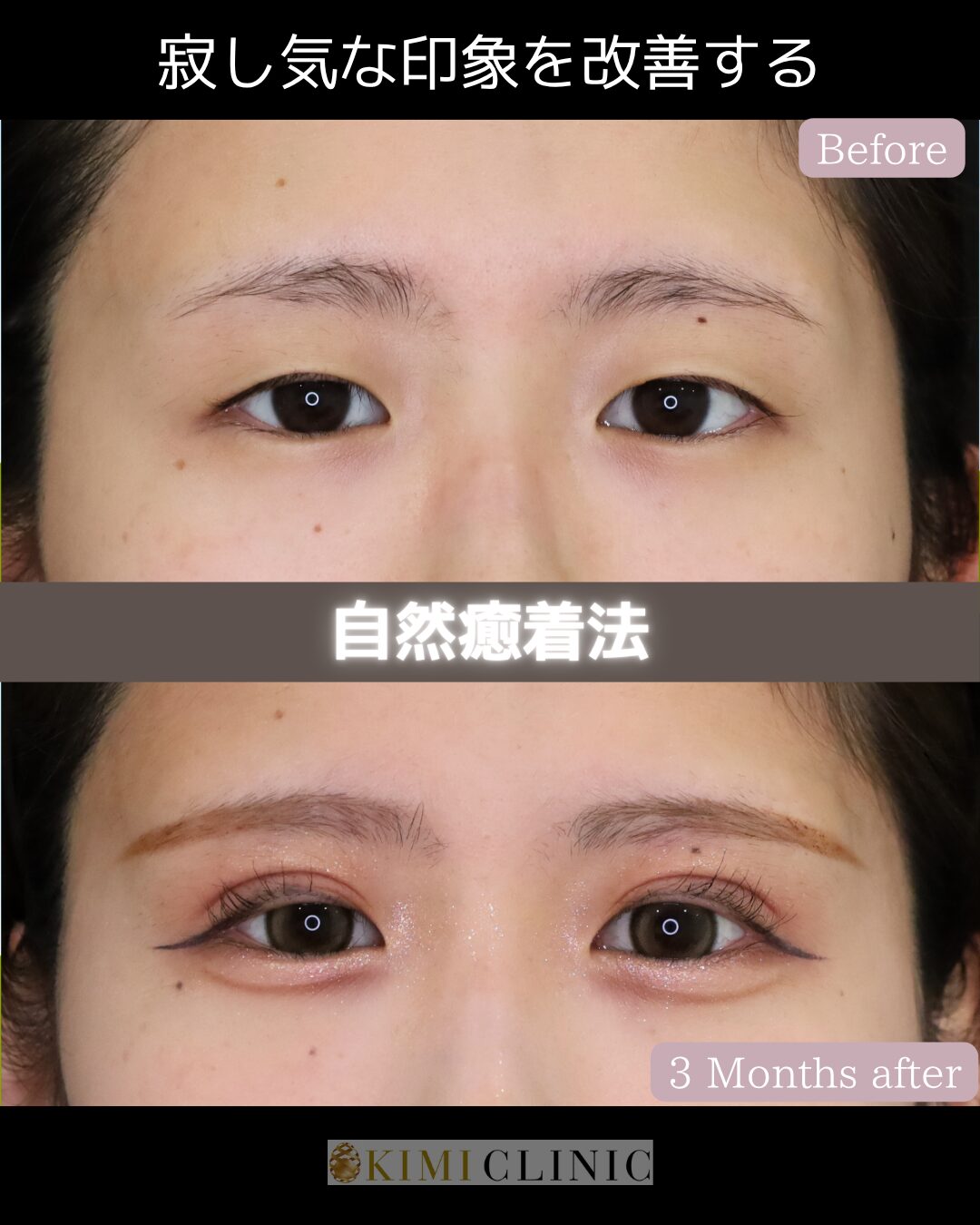 「キミクリの自然癒着法」の術前・術後比較Before写真