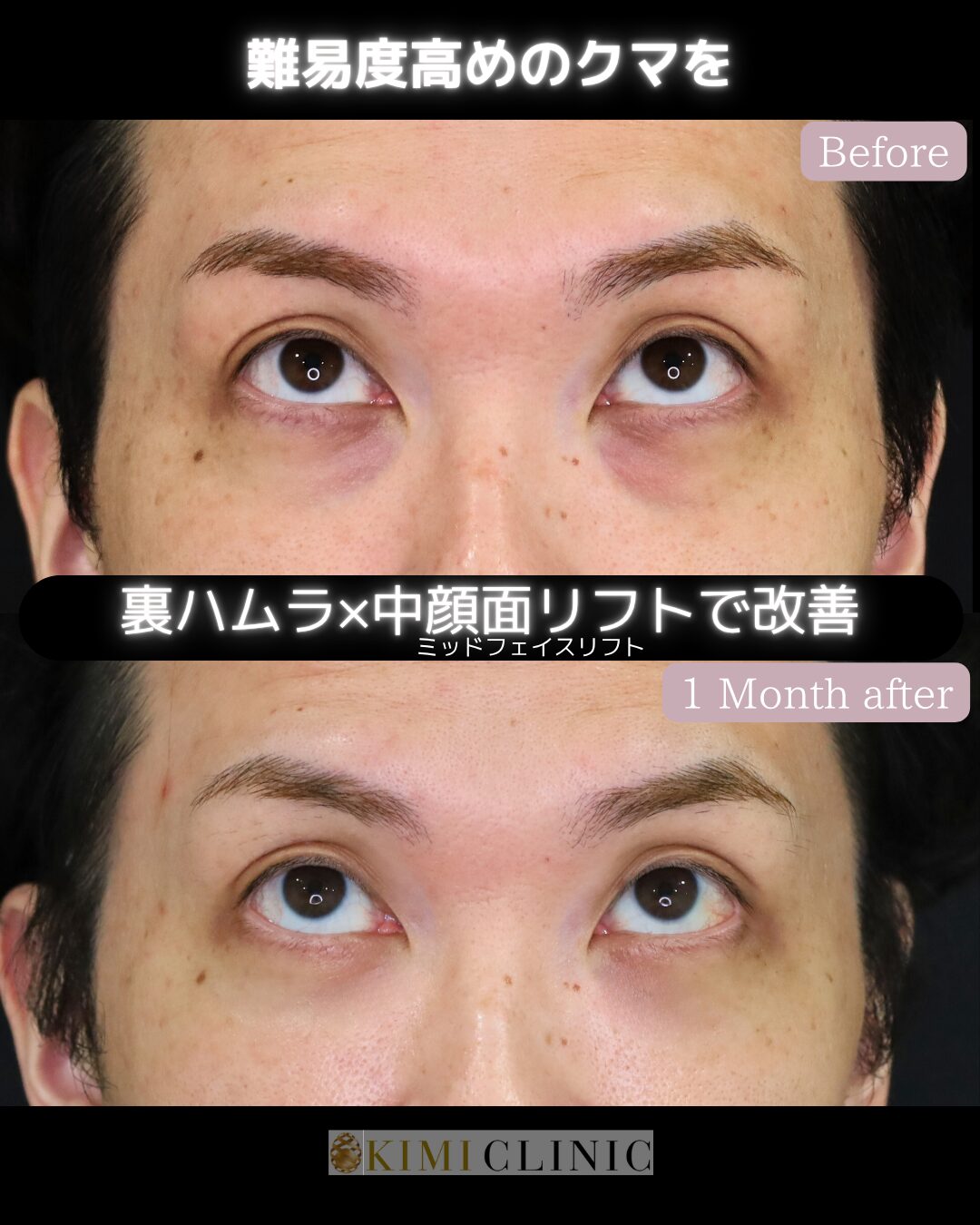 「裏ハムラ×中顔面（ミッドフェイス）リフト」の術前・術後比較Before写真