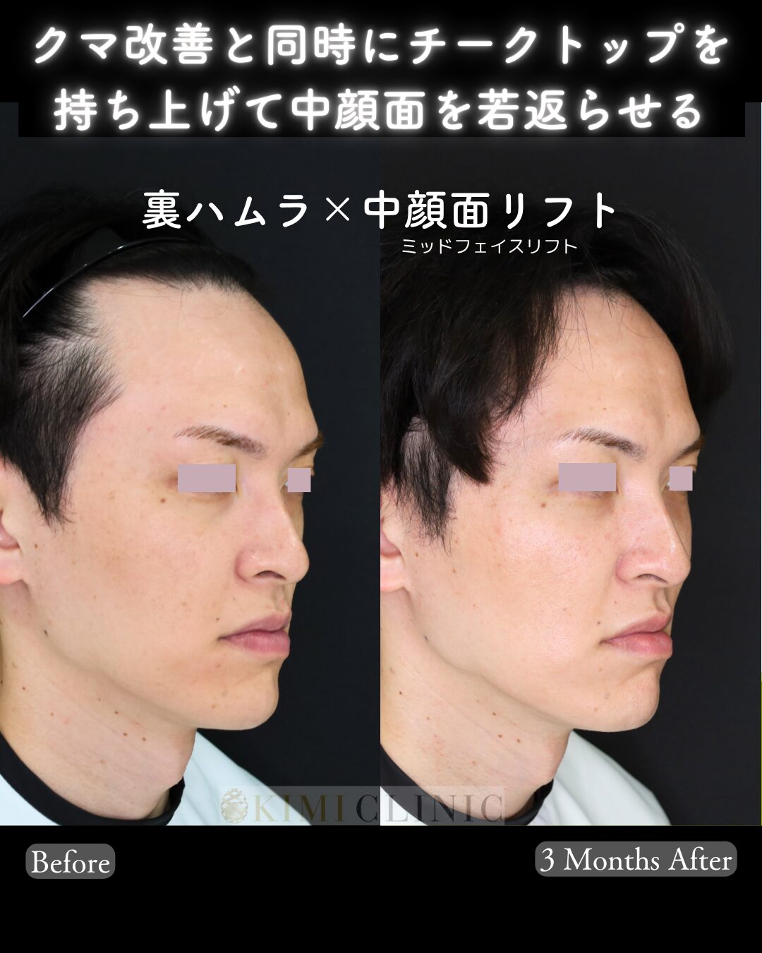 「裏ハムラ×中顔面（ミッドフェイス）リフト」の術前・術後比較Before写真