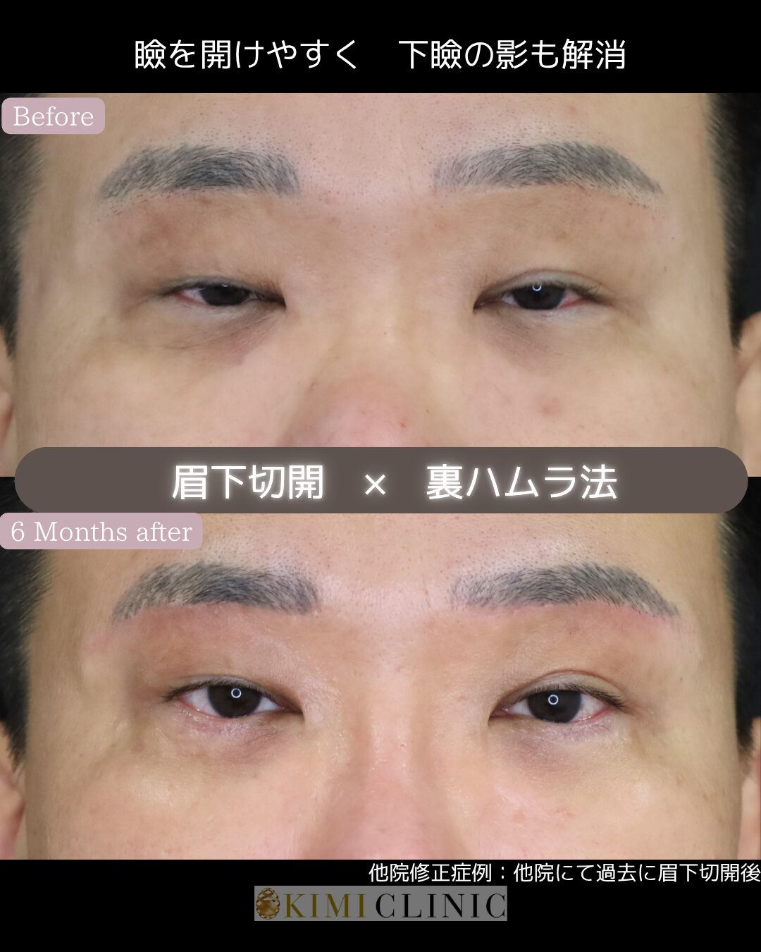 「眉下リフト × 裏ハムラ」の術前・術後比較Before写真