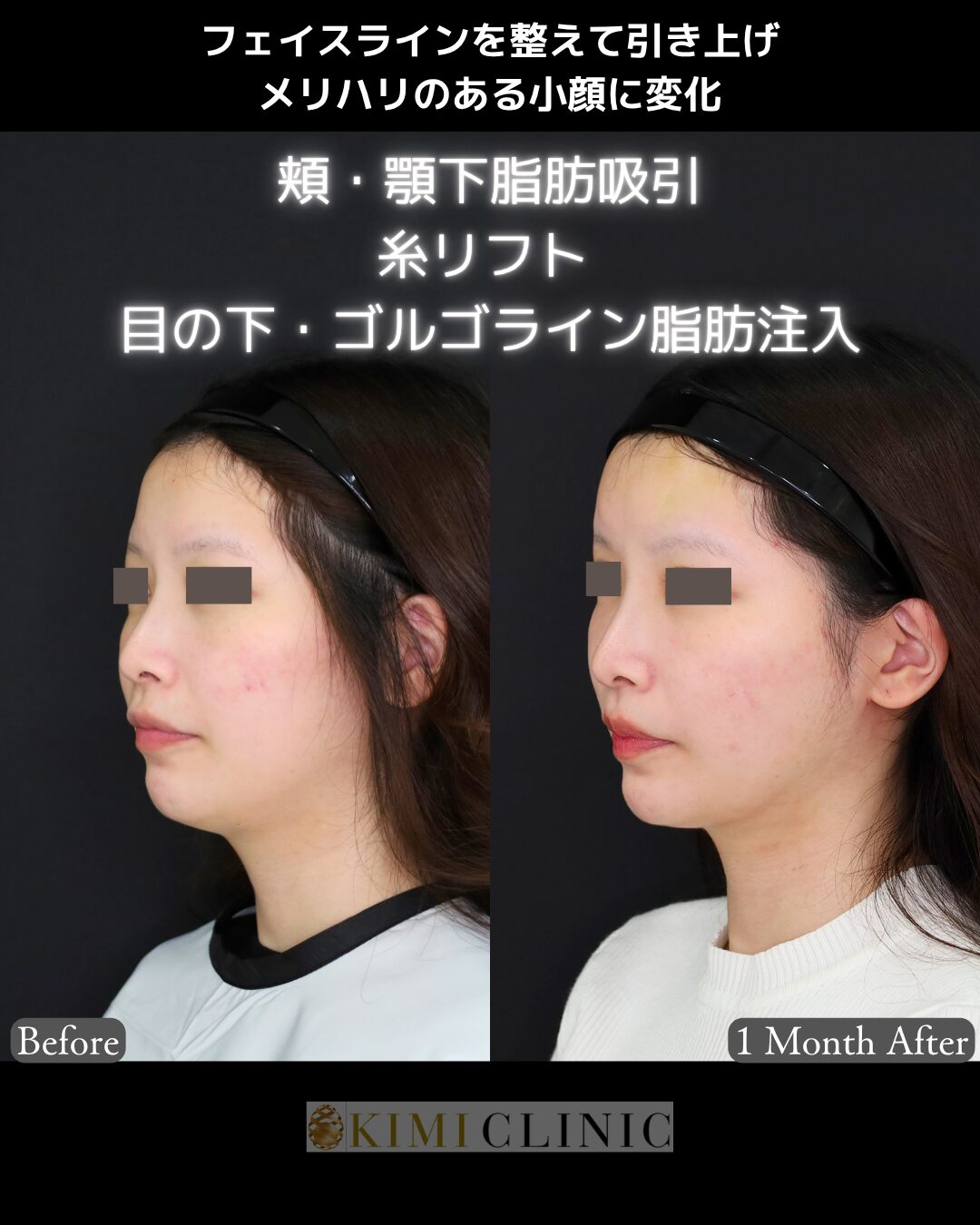 「サクションリフト（顔の脂肪吸引×糸リフト）＆目の下・ゴルゴラインの脂肪注入」の術前・術後比較Before写真