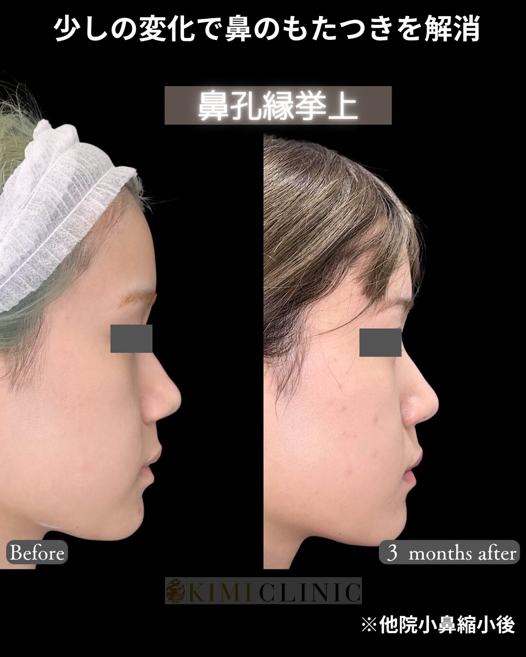 「鼻孔縁挙上」の術前・術後比較Before写真