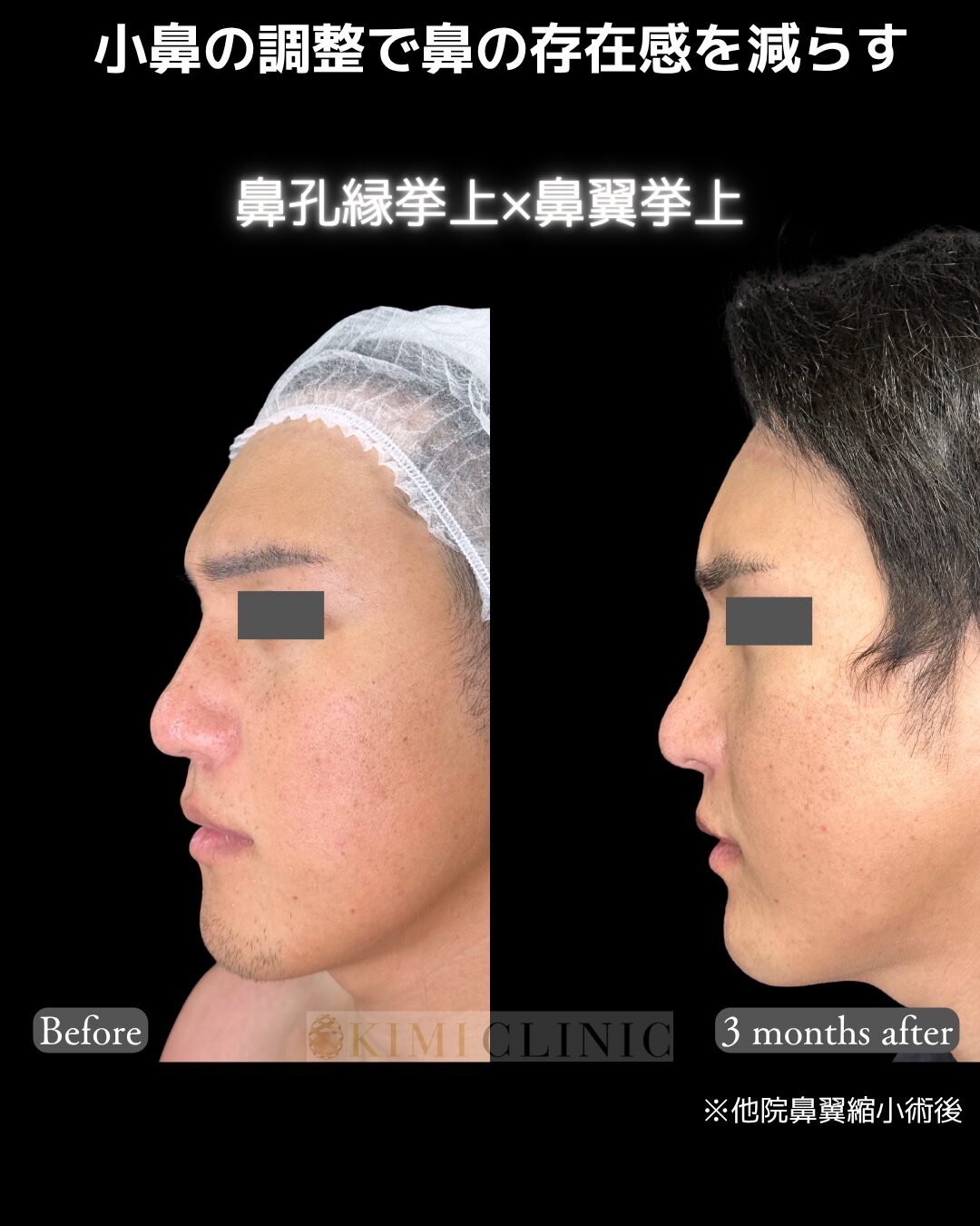 「鼻孔縁挙上 × 鼻翼挙上」の術前・術後比較Before写真