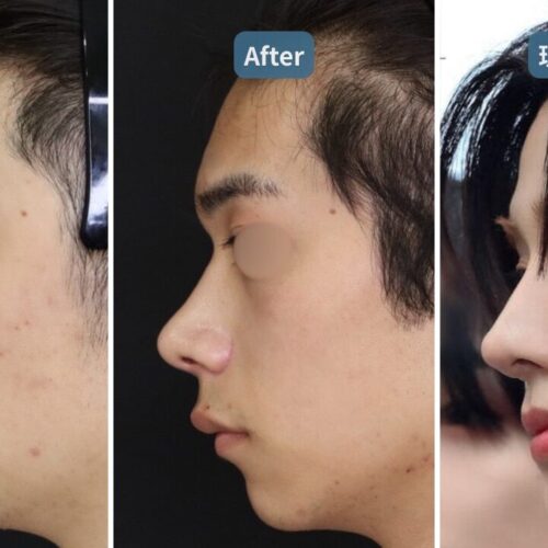 【症例解説】【鷲鼻修正×最新術式】プリザベーションライノプラスティで韓国アイドルのような自然な鼻筋へ