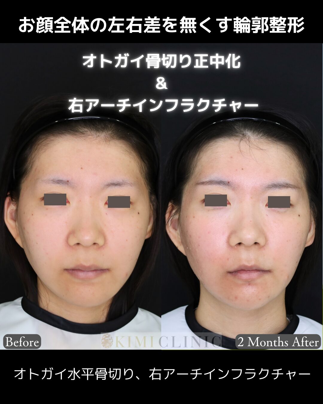 「お顔全体の左右差を無くす輪郭整形（骨切り）」の術前・術後比較Before写真