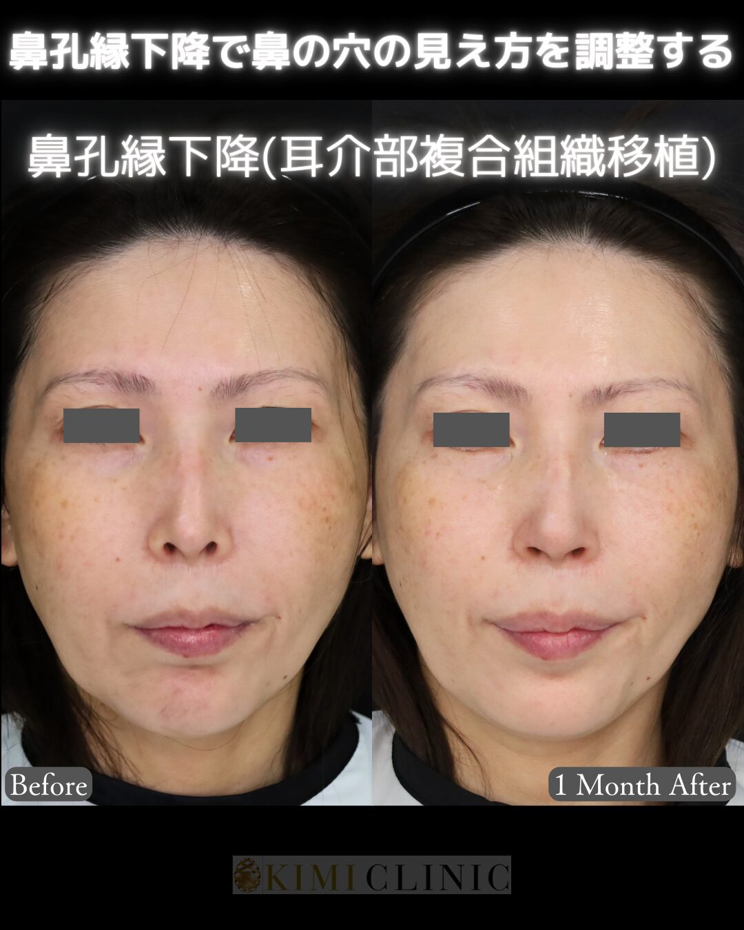 「鼻孔縁下降（耳介部からの複合組織移植）」の術前・術後比較Before写真