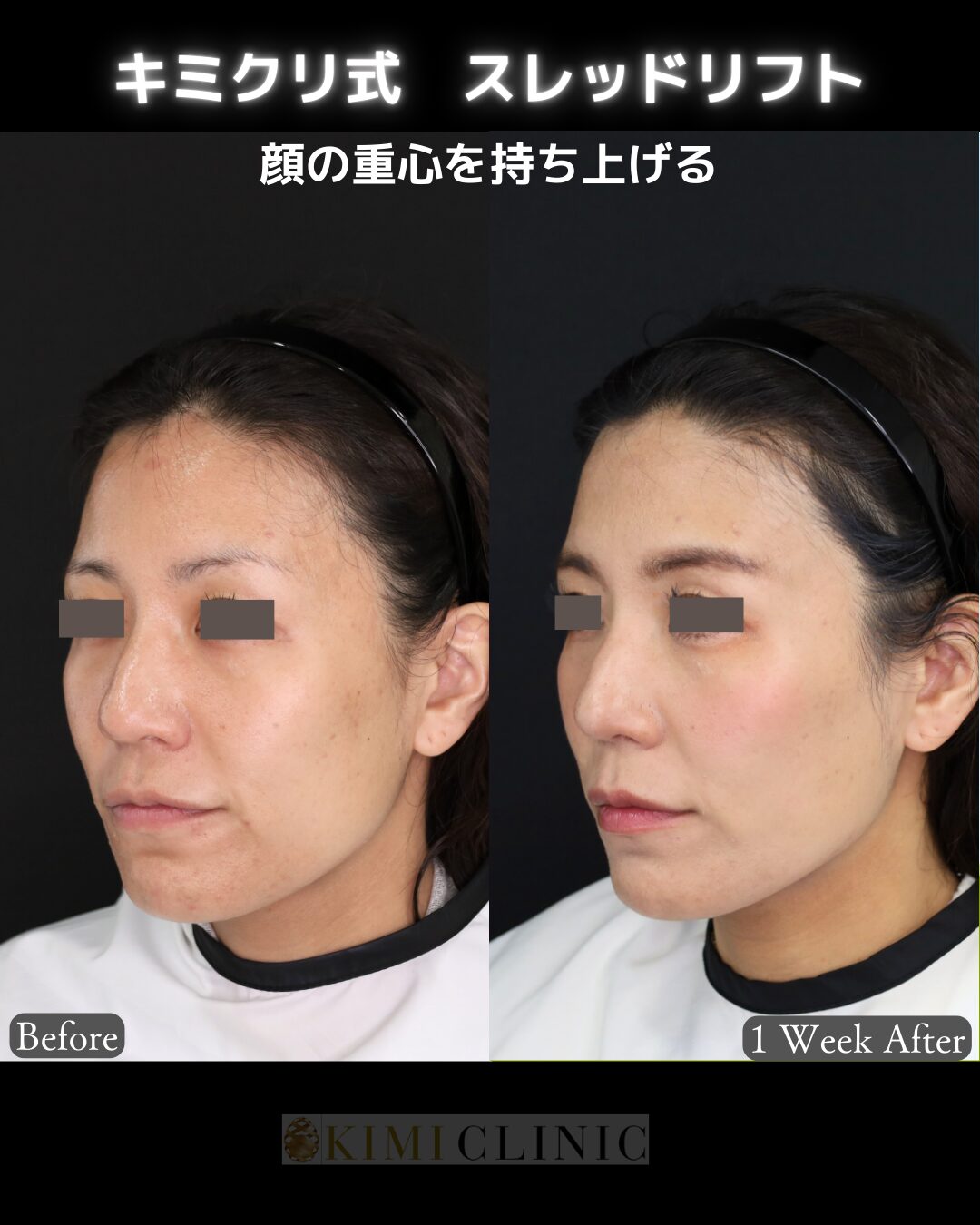 「キミクリ式糸リフト」の術前・術後比較Before写真