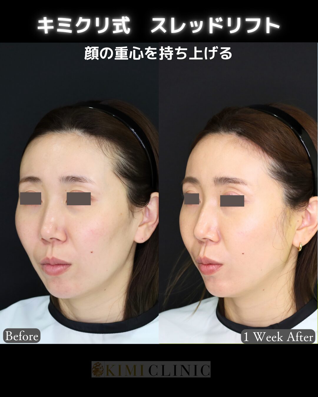 「キミクリ式糸リフト」の術前・術後比較Before写真