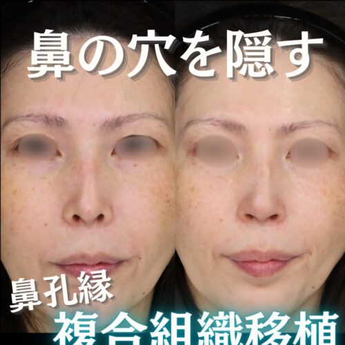 【症例解説・鼻孔縁挙上】鼻孔縁の形が、鼻の印象を大きく左右します