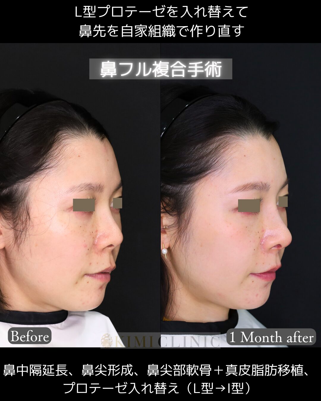 「プロテーゼ入れ替え・鼻フル複合手術」の術前・術後比較Before写真