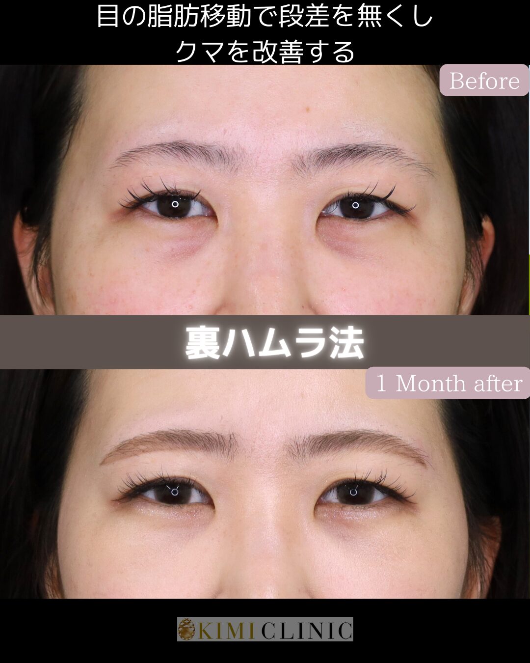 「裏ハムラ法」の術前・術後比較Before写真