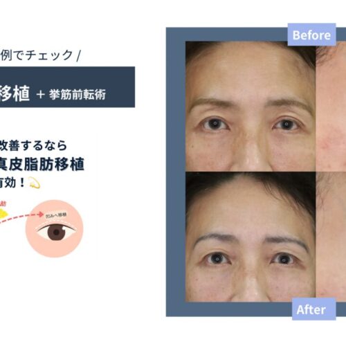 【症例解説・窪み目への真皮脂肪移植】二重ラインが不安定？それ、窪み目が原因かもしれません。